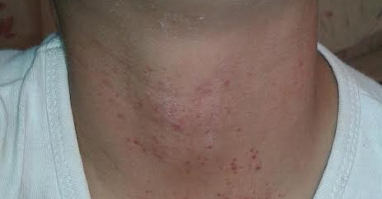 براءة وشقيقاها.. نزيف المرض واللجوء براءة وشقيقاها.. نزيف المرض واللجوء