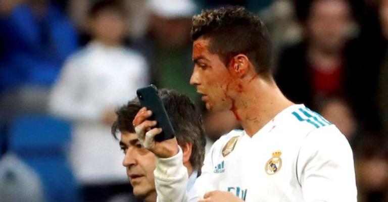 أول تمرين لرونالدو بعد إصابته بجرح في الوجه (صور) أول تمرين لرونالدو بعد إصابته بجرح في الوجه (صور)