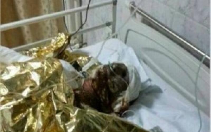 إصابة 3 أطفال سوريين ووالدهم إثر حريق في الزعتري