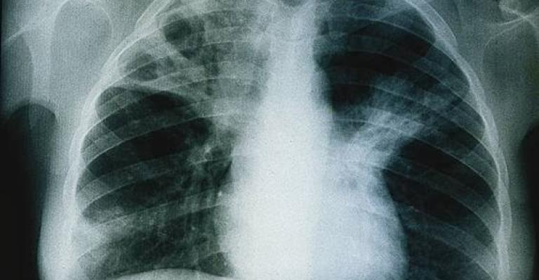 421 حالة سل خلال 2015 نصفها بين الوافدين