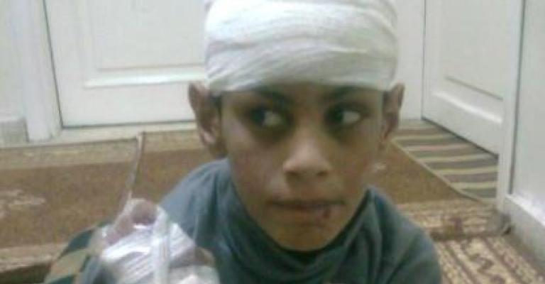 احد ضحايا مراكز المعاقين يخضع للتأهيل بواسطة الخيل