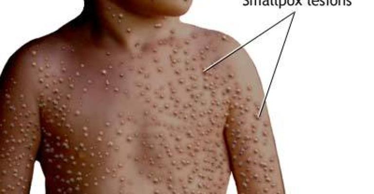 اختفاء دواء الجدري من مراكز الصحة في الشونة الجنوبية