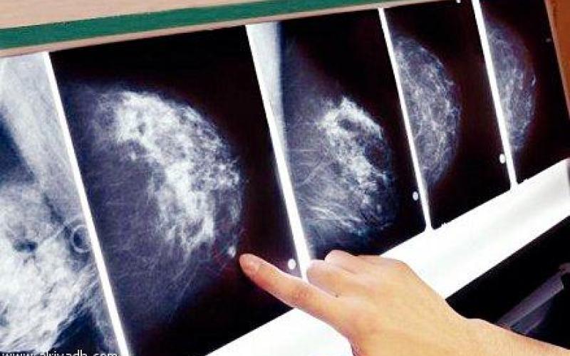 سرطان الثدي بين الرجال في الأردن ..حقيقة مغفلة
