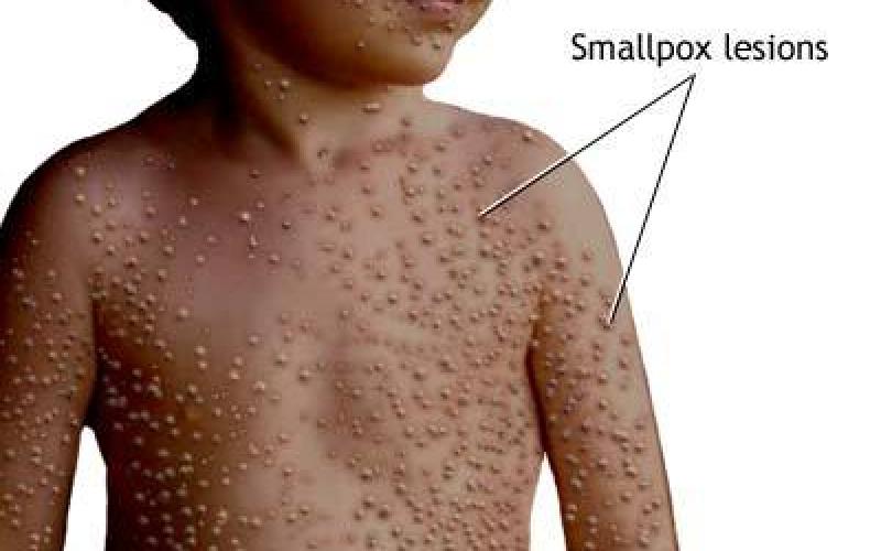 اختفاء دواء الجدري من مراكز الصحة في الشونة الجنوبية